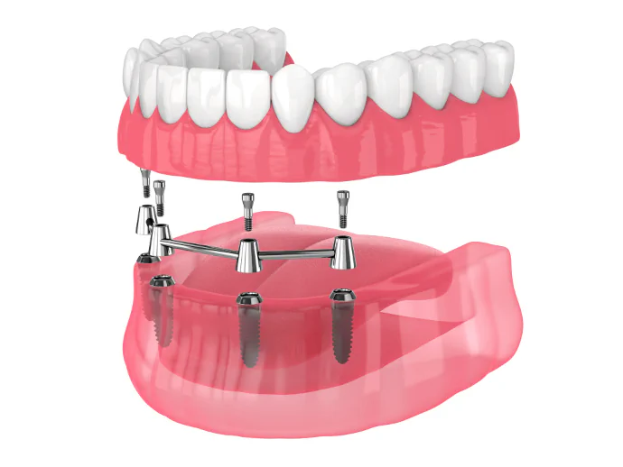 Full-Mouth Dental Implants in Panama City Beach, FL at West Bay Dental