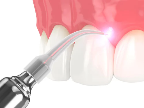 Soft-Tissue Dental Laser in Panama City Beach, FL at West Bay Dental
