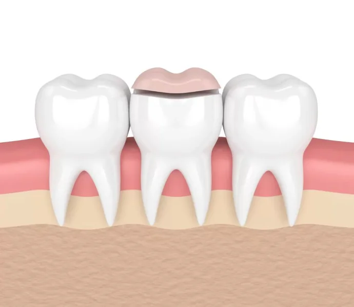 Dental Inlays and Onlays