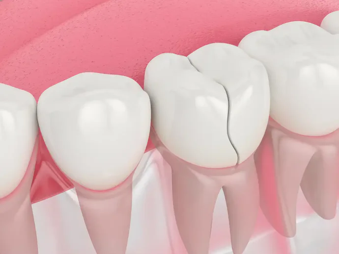 Tooth Repair Options in Panama City Beach, FL at West Bay Dental